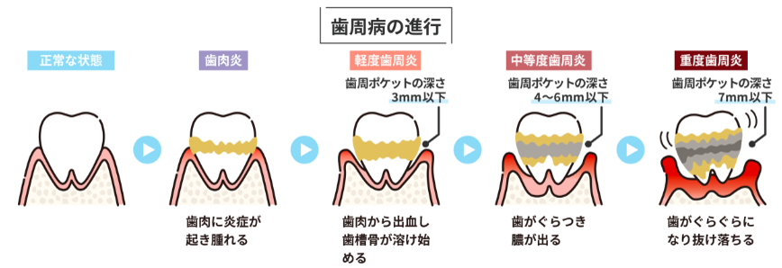 歯周病の段階